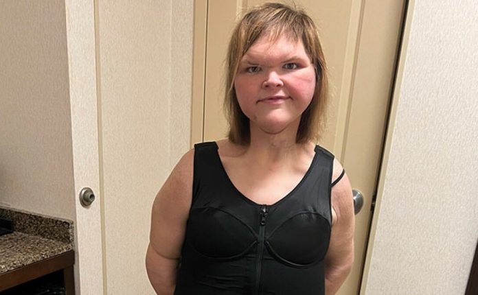 1000-Lb. Sisters’ Tammy Slaton Barely Recognizable After Showing Off Skin Removal Surgery Results