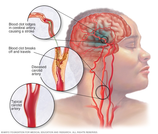 10 Warning Signs of Stroke One Month Before