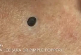 Blackheads: Causes, Symptoms, and Treatments