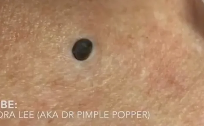 Blackheads: Causes, Symptoms, and Treatments