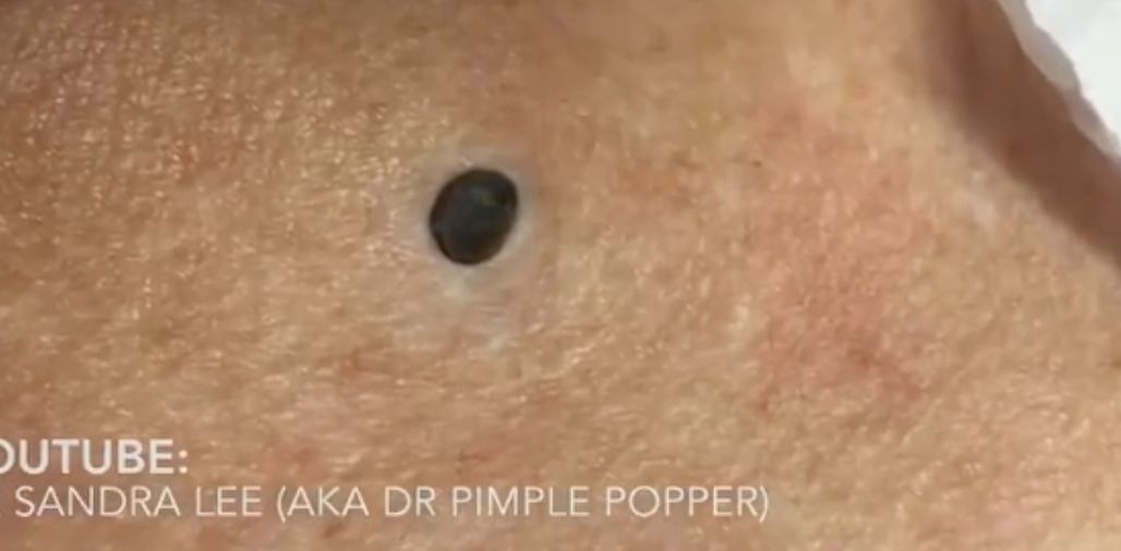 How to Treat and Prevent Deep Blackheads — Professionally or at Home