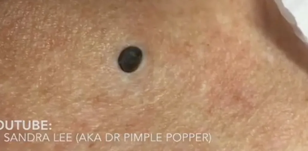 Blackheads: Causes, Symptoms, and Treatments