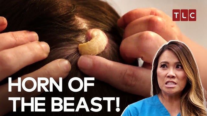 Dr. Pimple Popper Removes A Potentially Cancerous Horn from a Woman's Head