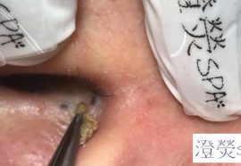 歷代級超深3洞黑頭！！！Super deep blackhead removal! - 澄熒SPA
