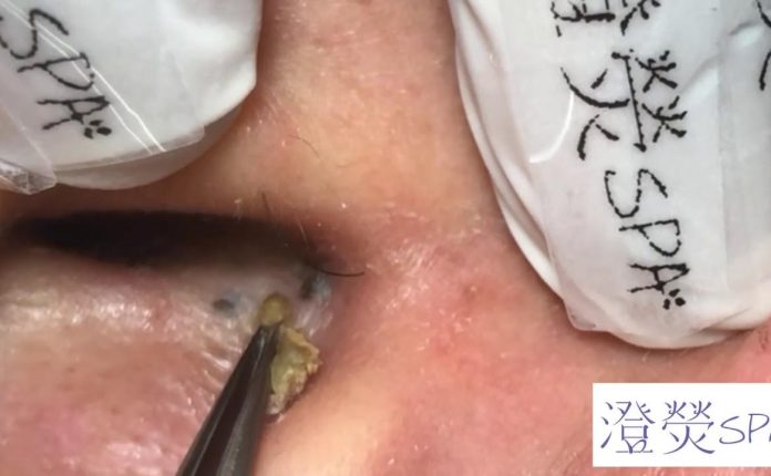 歷代級超深3洞黑頭！！！Super deep blackhead removal! - 澄熒SPA