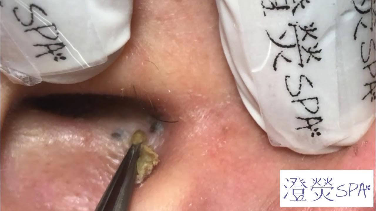 歷代級超深3洞黑頭!!!Super deep blackhead removal! - 澄熒SPA