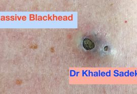 How to Treat and Prevent Deep Blackheads — Professionally or at Home