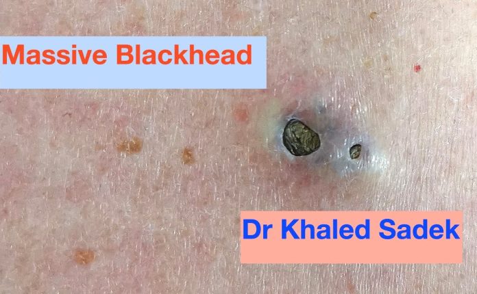 How to Treat and Prevent Deep Blackheads — Professionally or at Home