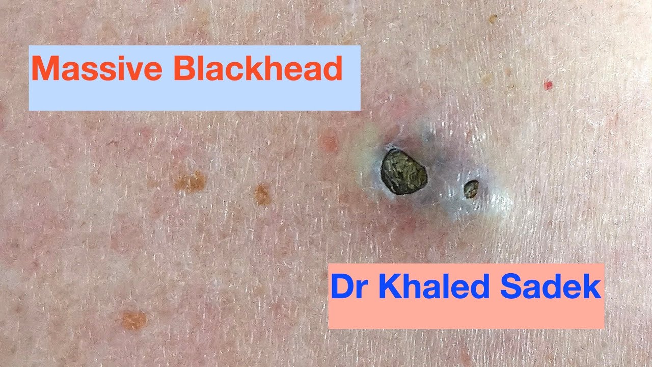 How to Treat and Prevent Deep Blackheads — Professionally or at Home