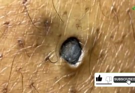 "Most Satisfying Huge Blackhead Removal, Skincare Transformation"