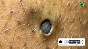 Big Blackhead Removal, Treatment & Prevention! (2 Videos)