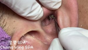 Professional Treatments for Ear Blackhead Removal (Video)