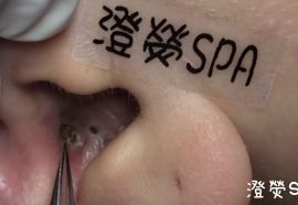 黑頭粉刺來了 More Ear Blackheads! - 澄熒SPA