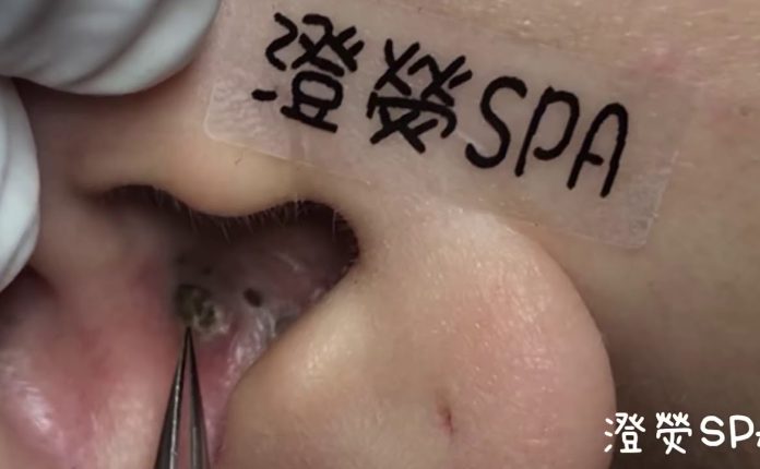 黑頭粉刺來了 More Ear Blackheads! - 澄熒SPA