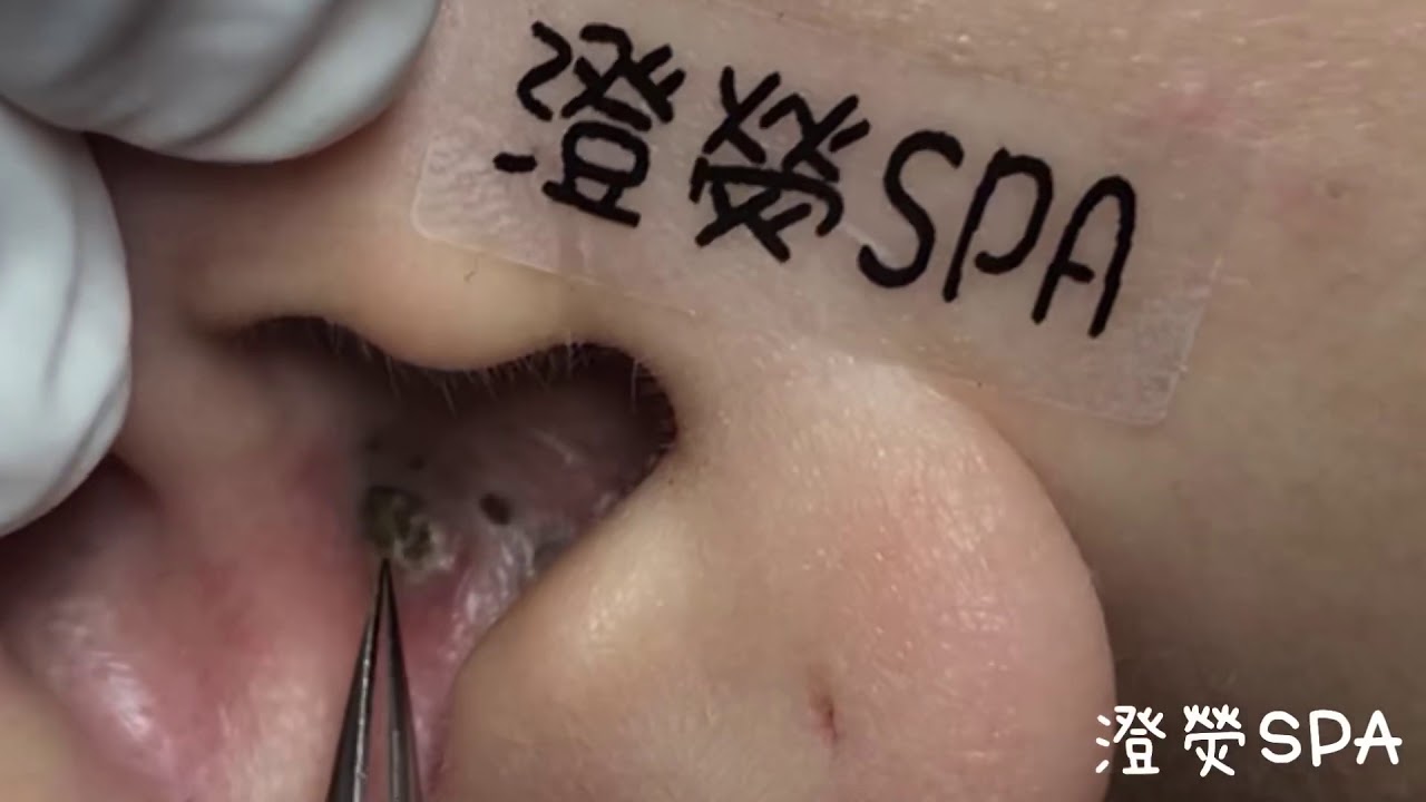 黑頭粉刺來了 More Ear Blackheads! - 澄熒SPA