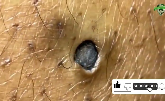"Most Satisfying Huge Blackhead Removal, Skincare Transformation"