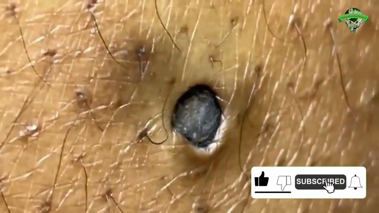 "Most Satisfying Huge Blackhead Removal, Skincare Transformation"
