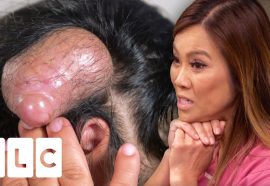 Dr Lee May Have Extracted The Biggest Pillar Cyst She Has Ever Seen!