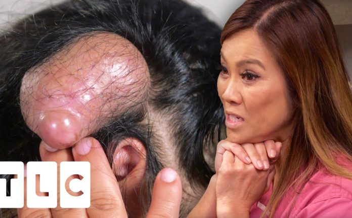 Dr Lee May Have Extracted The Biggest Pillar Cyst She Has Ever Seen!