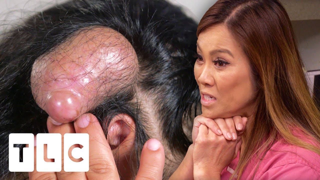 Dr Lee May Have Extracted The Biggest Pillar Cyst She Has Ever Seen!