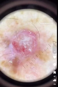 Doctor shares shocking video of ‘worst’ skin cancer he’s ever seen and issues urgent warning