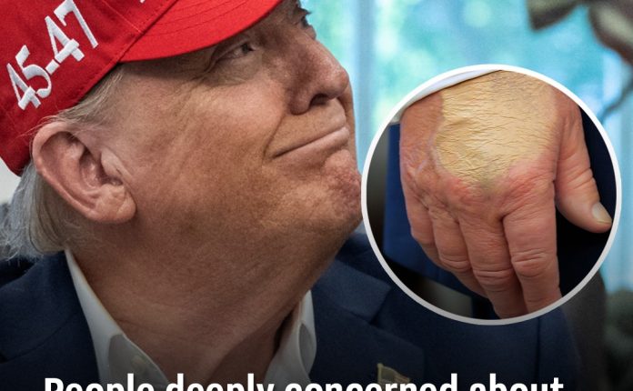 People deeply concerned about Trump's health after new photo reveals 'amount of foundation' on hand