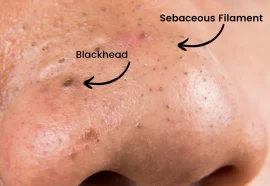 How Can You Tell The Difference Between A Blackhead And A Sebaceous FIlament? 
