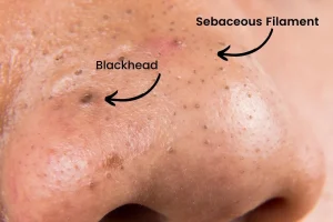 What are blackheads? Facts and The Best Treatments (Video Below)