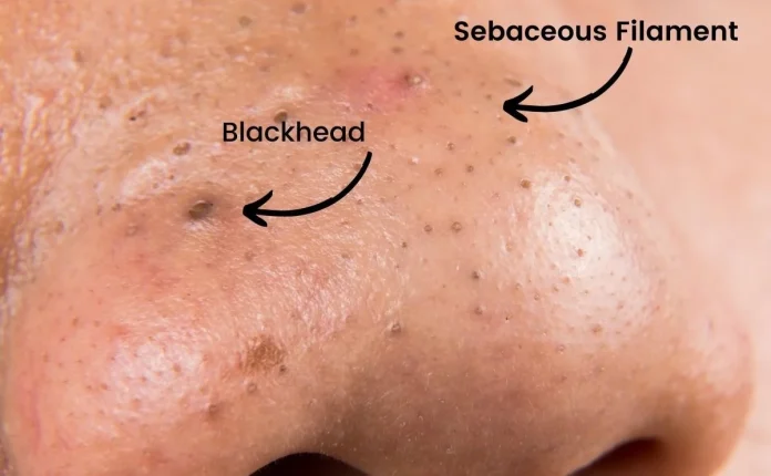 How Can You Tell The Difference Between A Blackhead And A Sebaceous FIlament? 