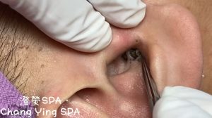 12 Ways to Get Rid of Blackheads (4 Videos)