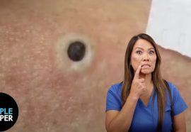 Get Rid of Blackheads: 4 Proven Ways (Plus How to Remove - Video)