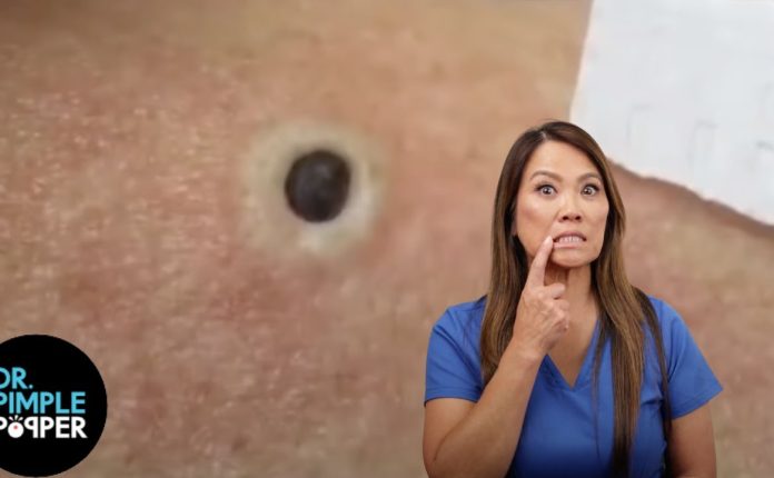 Get Rid of Blackheads: 4 Proven Ways (Plus How to Remove - Video)