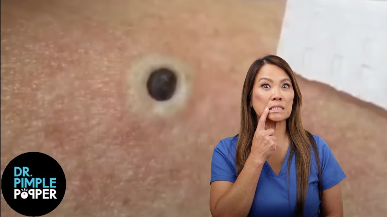 Get Rid of Blackheads: 4 Proven Ways (Plus How to Remove - Video)