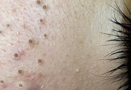 What if I have a blackhead?