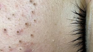 How Can I Prevent Pimples from Forming? (Video Below)