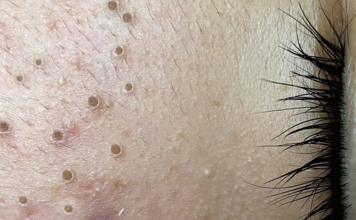 What if I have a blackhead?