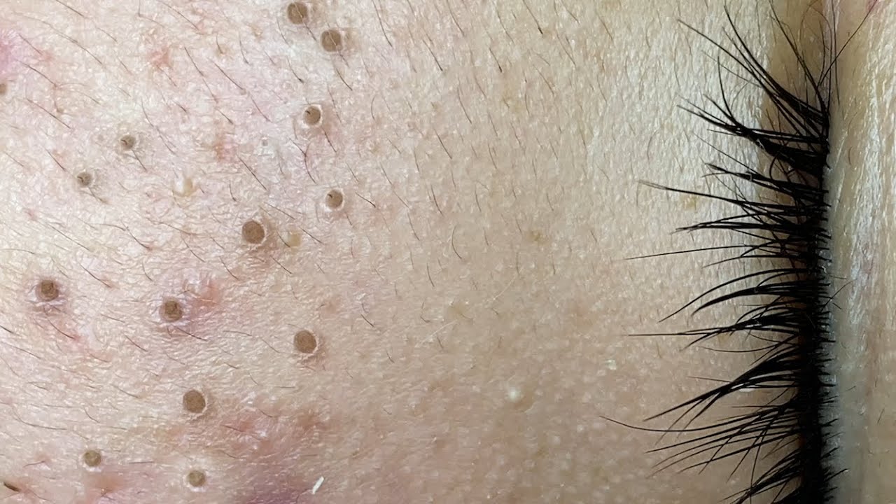 What if I have a blackhead?
