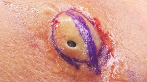 What looks like a single, gigantic blackhead on the outside actually hides a super dry and aged…? (Video)