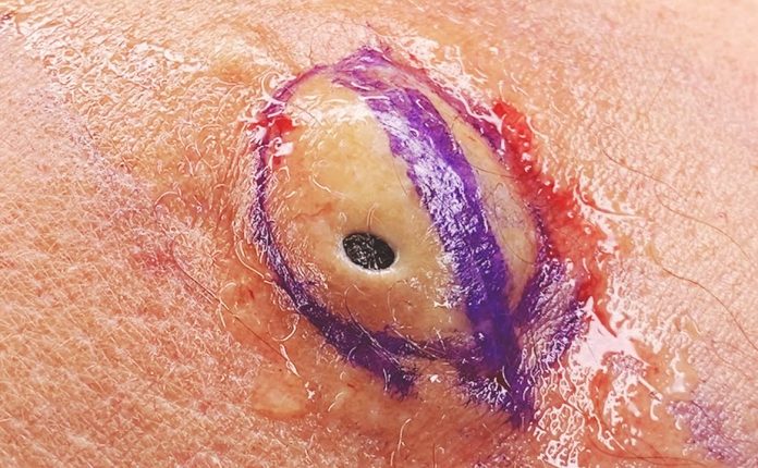 What looks like a single, gigantic blackhead on the outside actually hides a super dry and aged...?