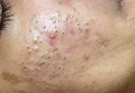 How To Get Rid of (and Prevent) Blackheads: 10 Solutions