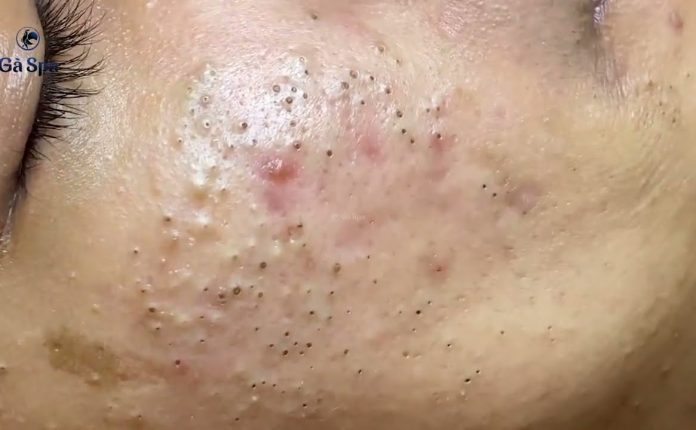 How To Get Rid of (and Prevent) Blackheads: 10 Solutions