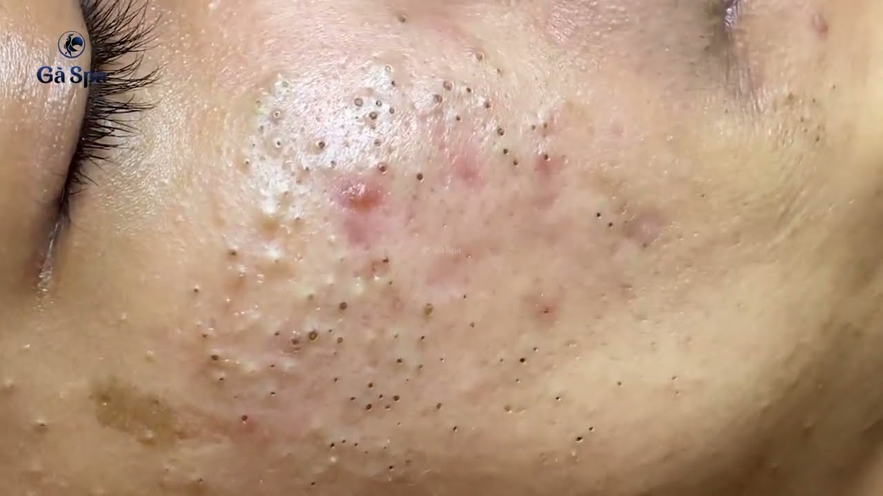 How To Get Rid of (and Prevent) Blackheads: 10 Solutions