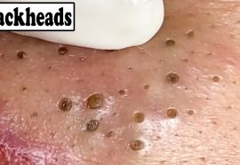 Blackheads: What They Look Like, Treatment & Prevention