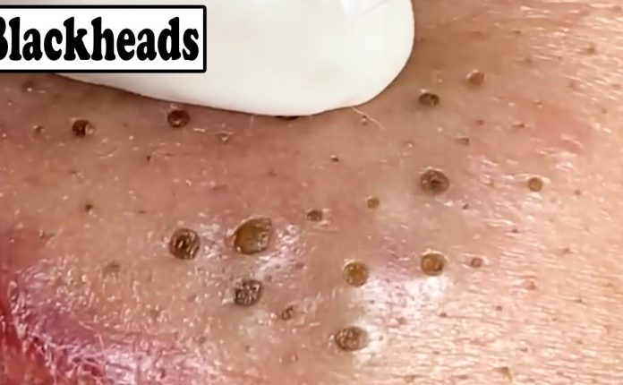 Blackheads: What They Look Like, Treatment & Prevention