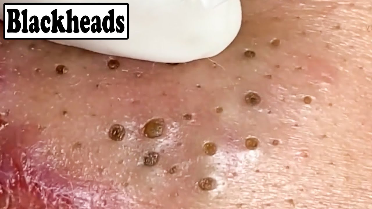 Blackheads: What They Look Like, Treatment & Prevention