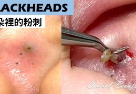 Why Blackheads Form in Your Ears and How to Treat Them