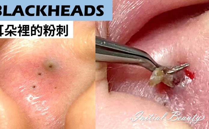 Why Blackheads Form in Your Ears and How to Treat Them