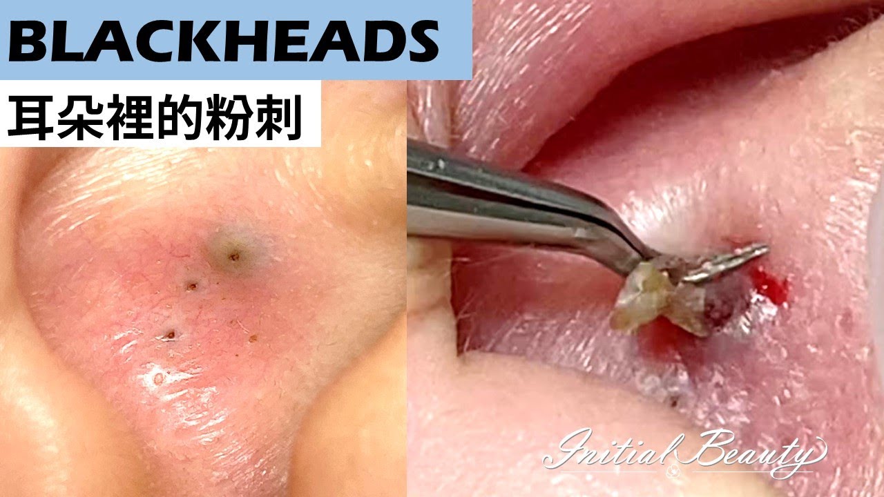 Why Blackheads Form in Your Ears and How to Treat Them