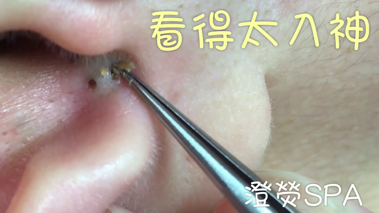Cleaning Ear Acne