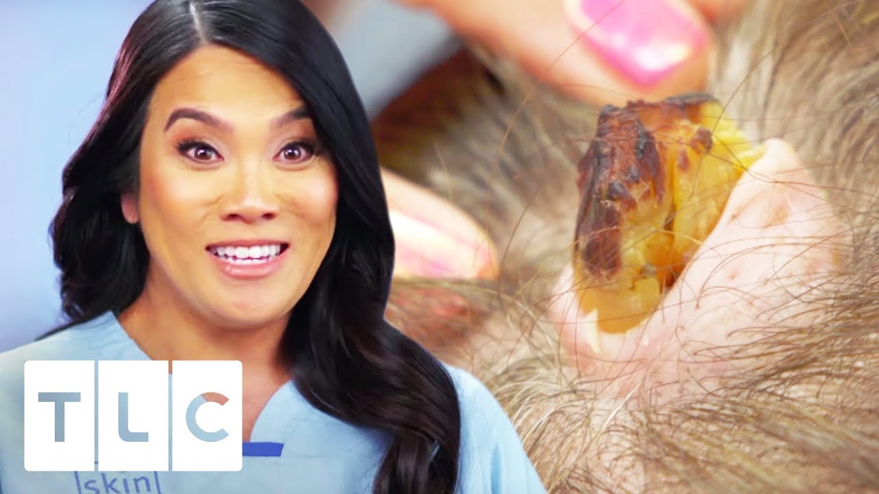 Removing A Horn-Like Growth And 6 Cysts From Woman's Head